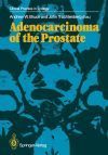 Adenocarcinoma of the Prostate