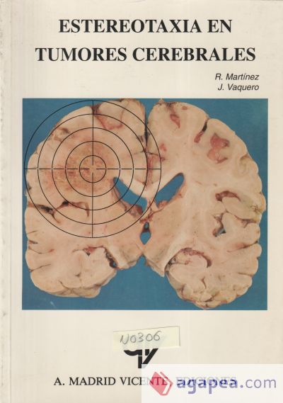 Estereotaxia en tumores cerebrales