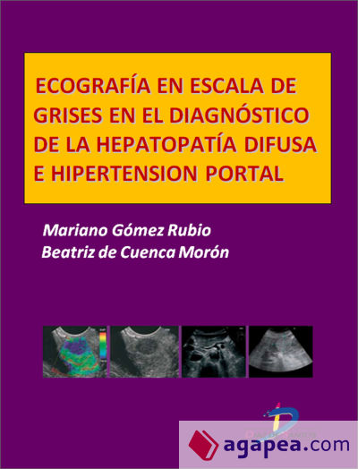 Ecografía en escala de grises en el diagnóstico dela hepatopatía difusa e hipertensión portal (Ebook)