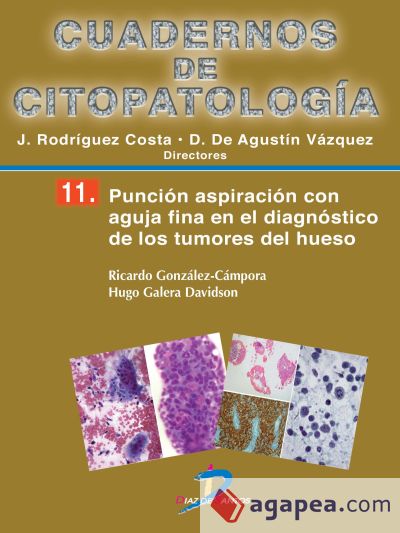 Punción aspiración con aguja fina en el diagnóstico de los tumores de hueso (Ebook)