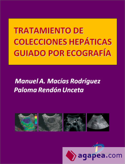 Tratamiento de colecciones hepáticas guiado por ecografía (Ebook)