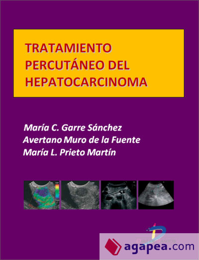 Tratamiento percutáneo del hepatocarcinoma (Ebook)