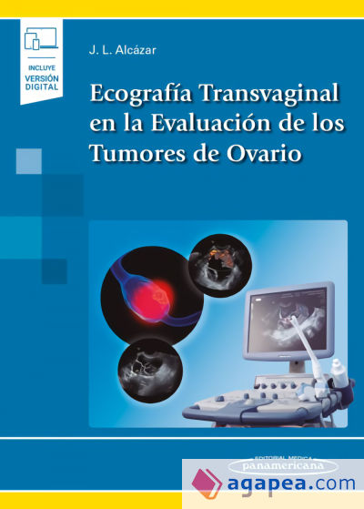 Ecografía Transvaginal en la Evaluación de los Tumores de Ovario (incluye versión digital)