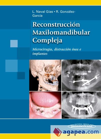 Reconstrucción Maxilomandibular Compleja