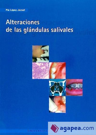 Alteraciones de las glandulas salivales