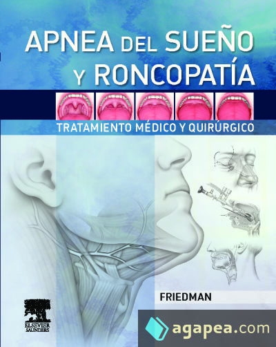 Apnea del sueño y roncopatía