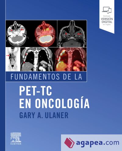 FUNDAMENTOS DE LA PET-TC EN ONCOLOGÍA