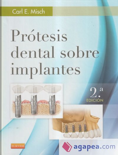 Prótesis dental sobre implantes