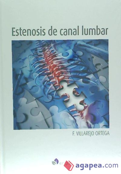 Estenosis del canal lumbar