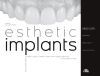 Esthetic Implants. How to Think about Complex Cases in Anterior Areas with a Global Approach to the Patient' S Smile