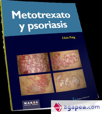 Metotrexato y psoriaris