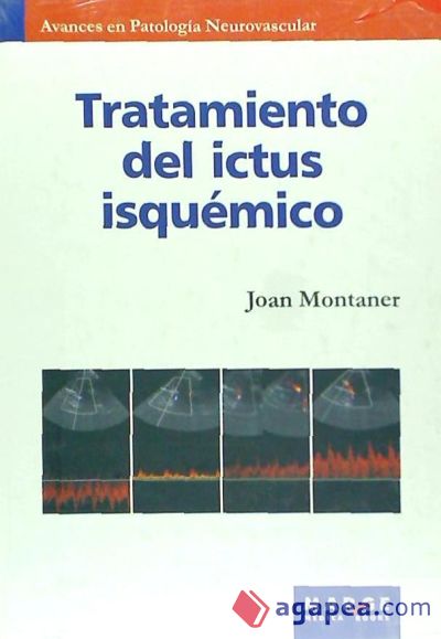 Tratamiento del ictus isquémico