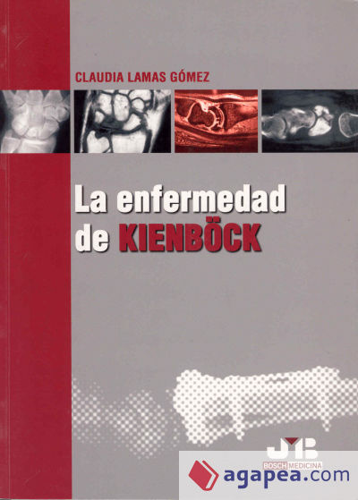 La enfermedad de Kienböck