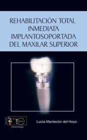 Portada de Rehabilitación total inmediata implantosoportada del maxilar superior: técnicas de carga inmediata