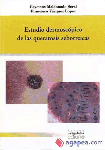 Estudio dermoscópico de las queratosis seborreicas