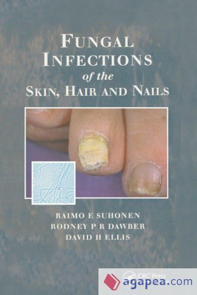 FUNGAL INFECTIONS OF THE SKIN AND NAILS - DAVID H. ELLIS,RAIMO E ...
