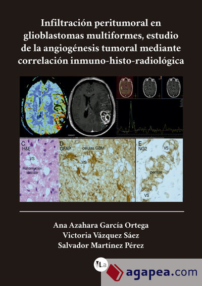 Infiltracion peritumoral en glioblastomas multiformes, estudio de la angiogénesis tumoral mediante correlación inmuno-histo-radiologica